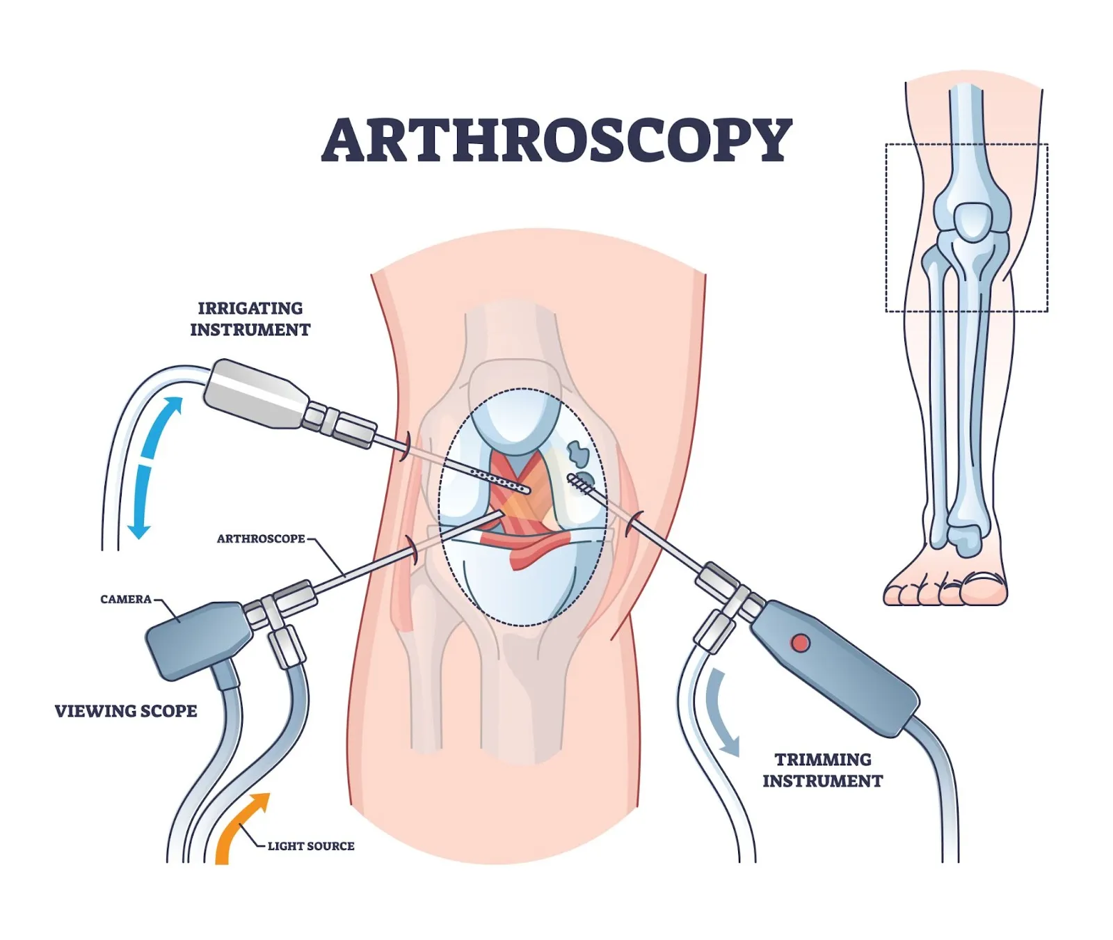 Arthroscopic Surgery (ACL, PCL Repair)