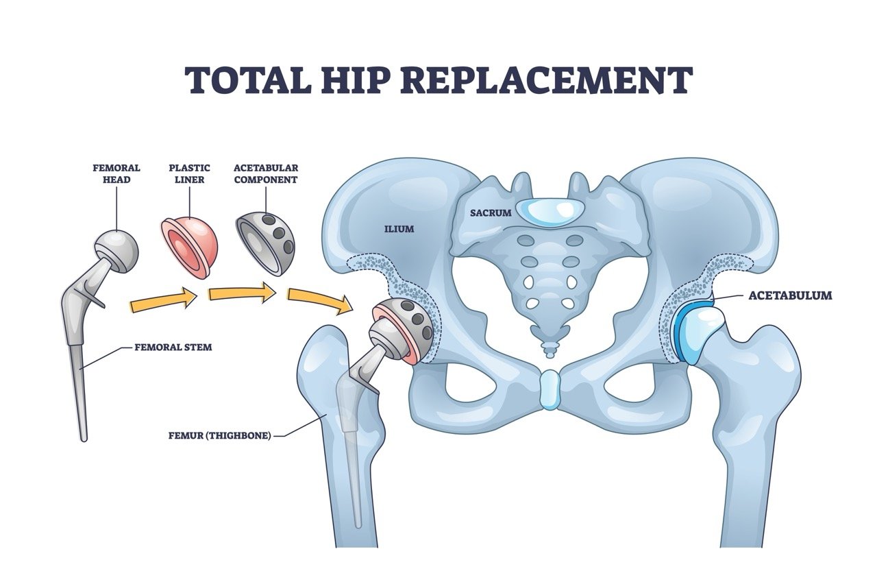 Total Hip Replacement